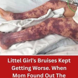 Little Girl’s Bruises Kept Getting Worse