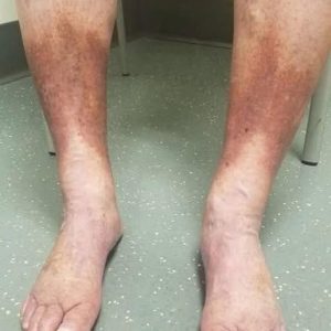 SAY GOODBYE TO VARICOSE