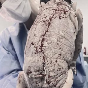 Baby born with an DIU peg…